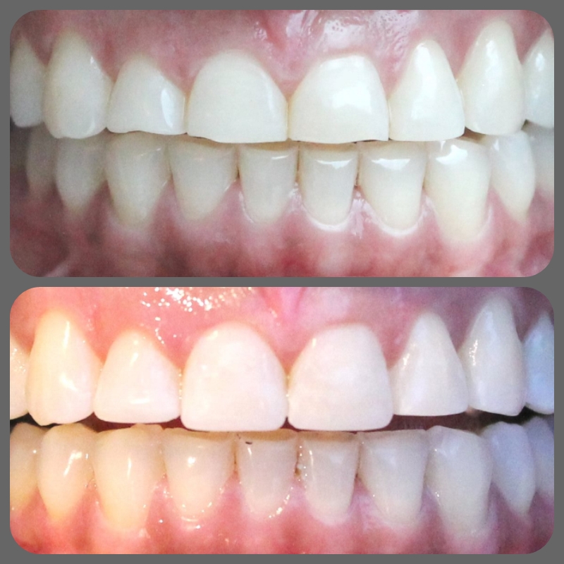 Tratamiento Bruxismo – Clínica Odontológica DentoBeli