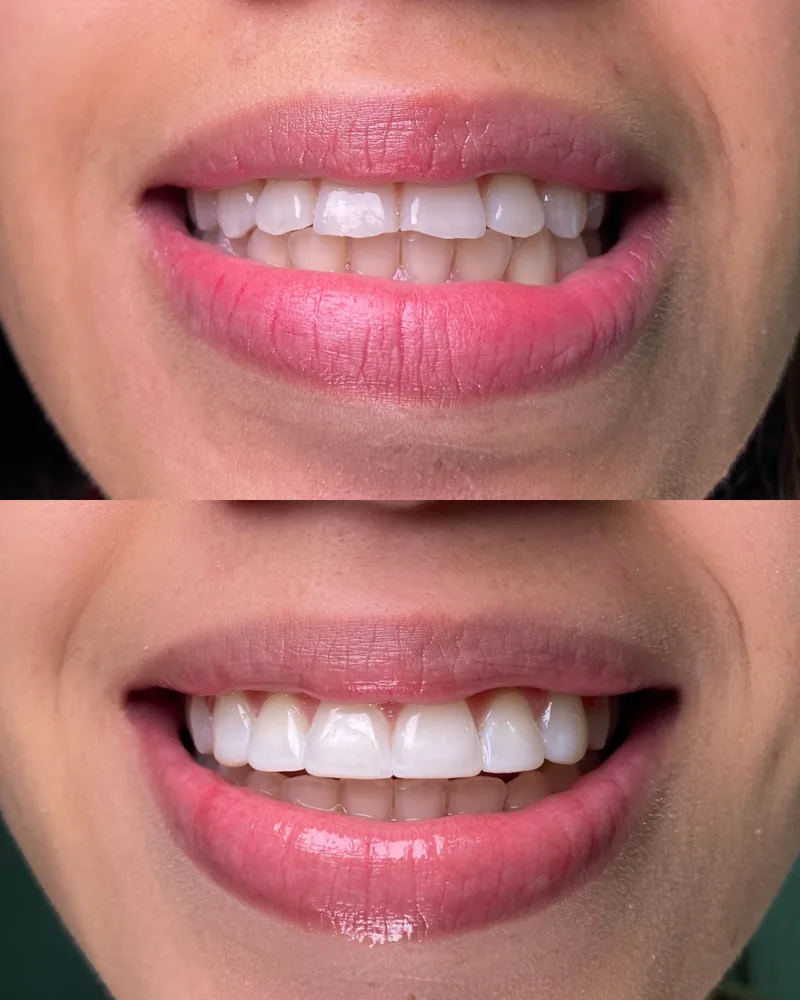 Antes y después de diseño de sonrisa