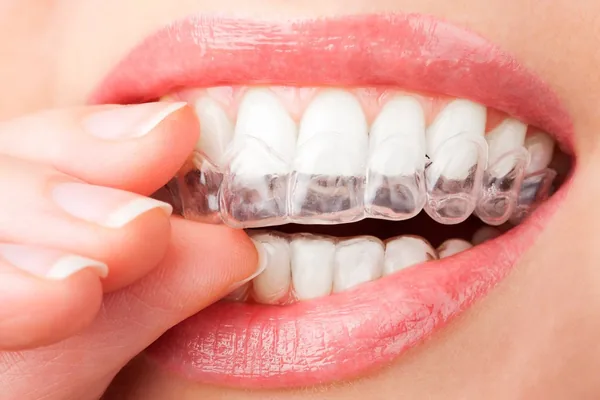 Alineadores Invisibles Invisalign