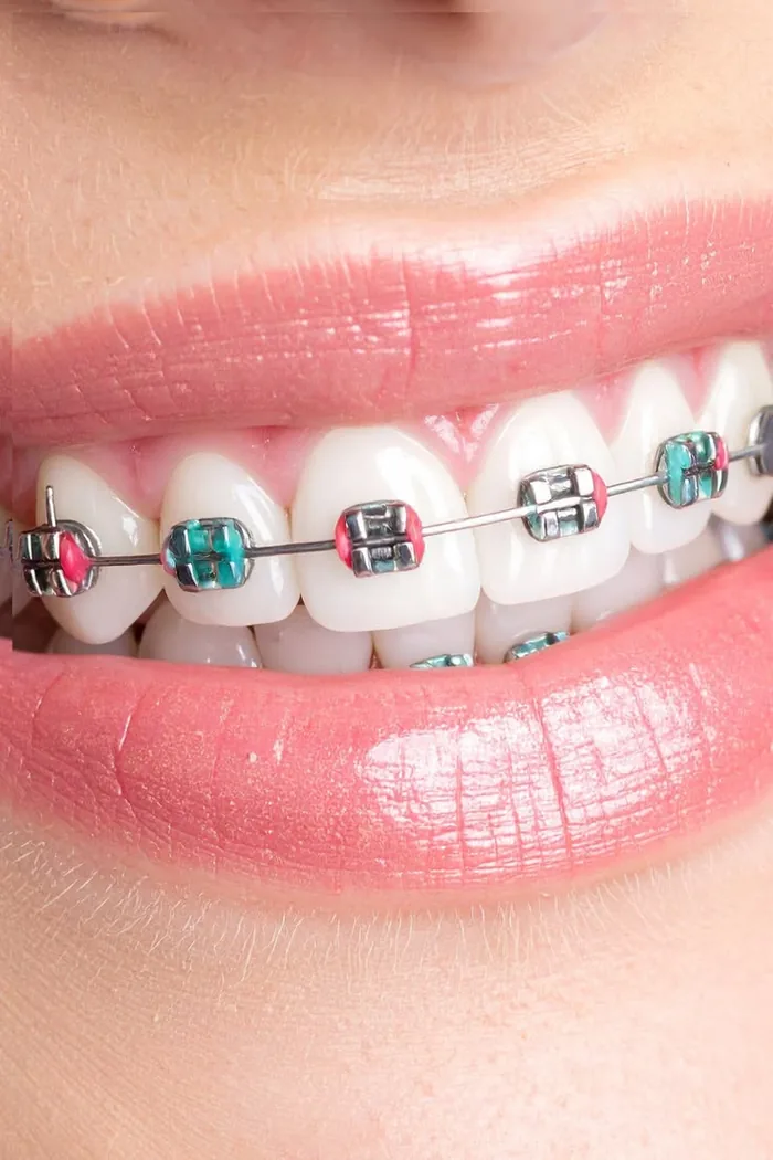 Brackets Metálicos Convencionales