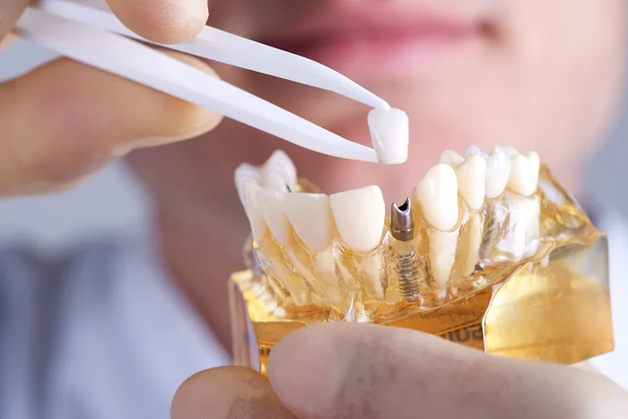 Rehabilitación oral